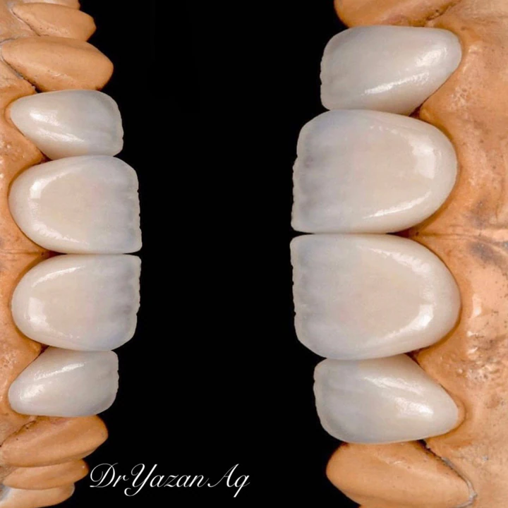 Caz Before & After realizat de Dr. Yazan Aq.