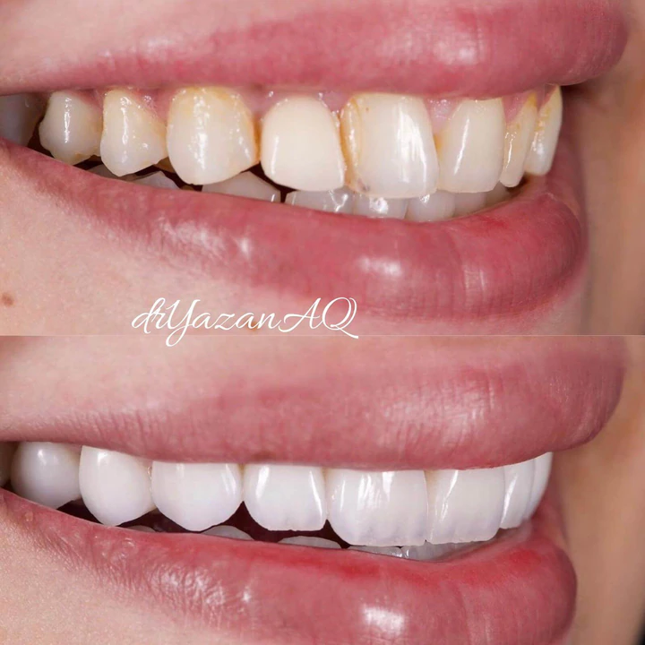 Caz Before & After realizat de Dr. Yazan Aq.