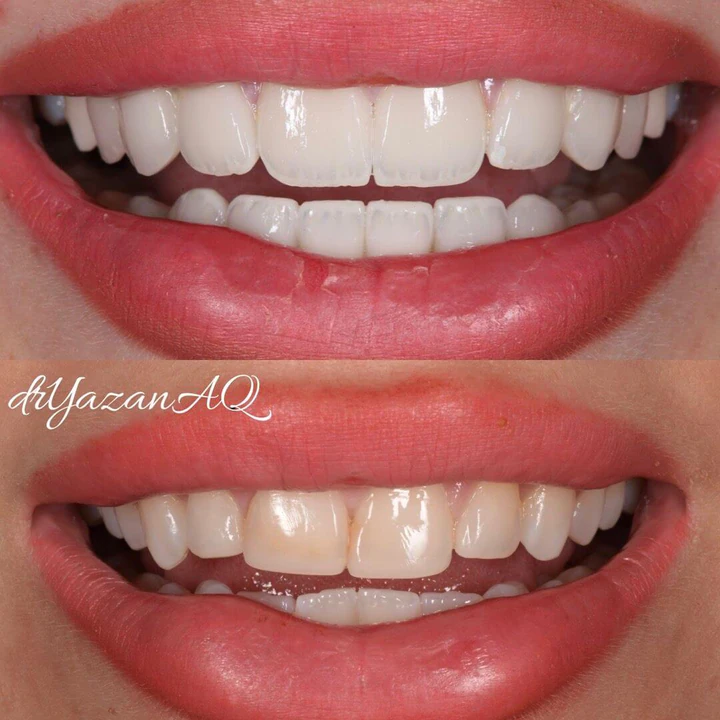 Caz Before & After realizat de Dr. Yazan Aq.