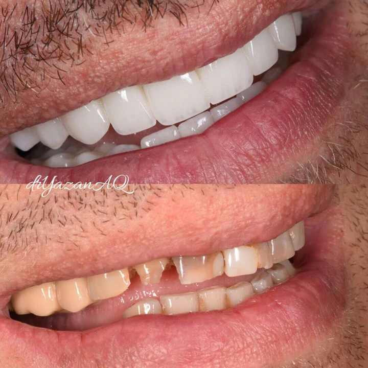 Caz Before & After realizat de Dr. Yazan Aq.