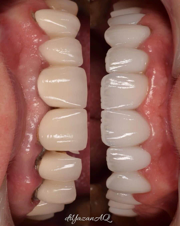 Caz Before & After realizat de Dr. Yazan Aq.