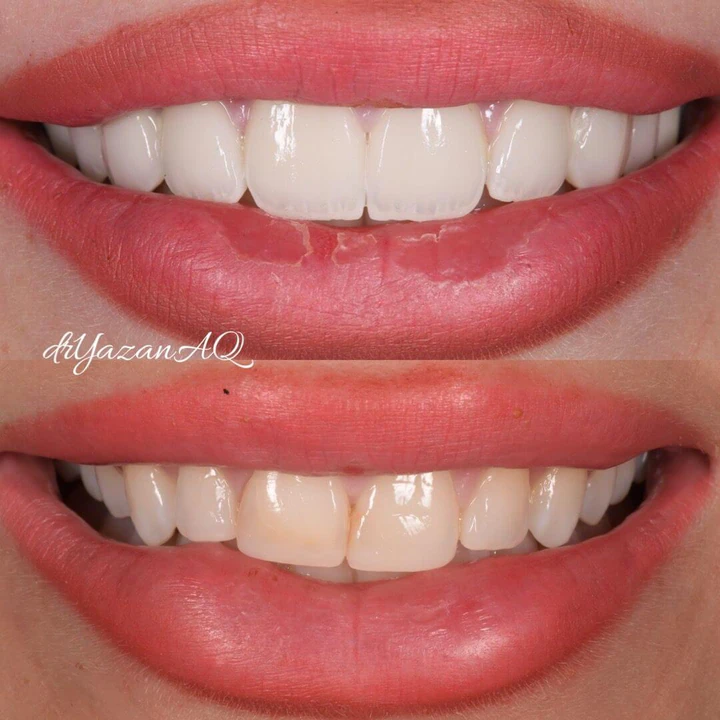 Caz Before & After realizat de Dr. Yazan Aq.