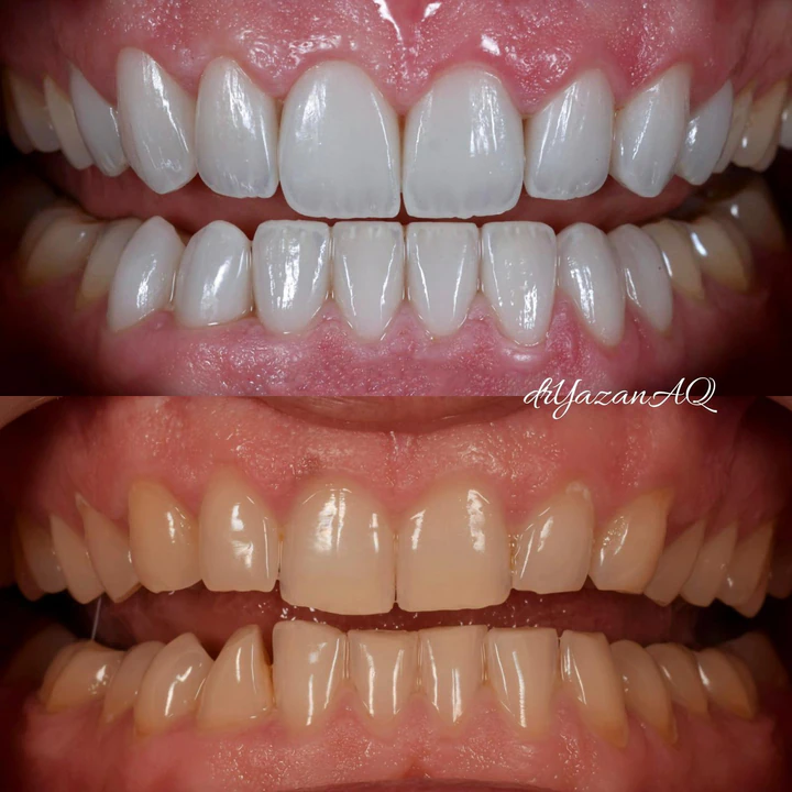 Caz Before & After realizat de Dr. Yazan Aq.