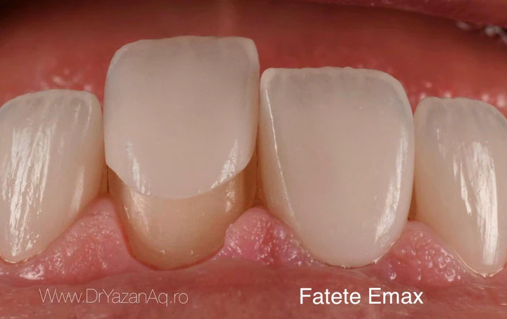 Caz Before & After realizat de Dr. Yazan Aq.