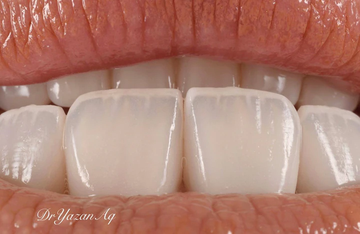Caz Before & After realizat de Dr. Yazan Aq.