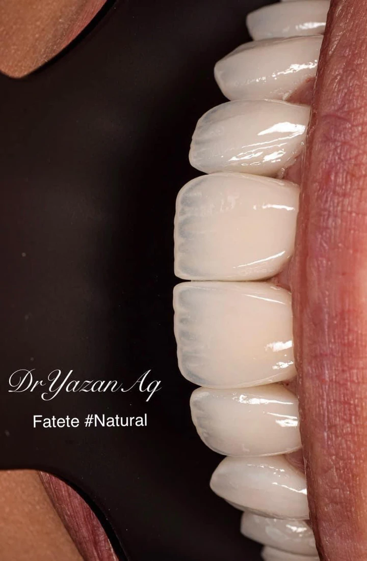 Caz Before & After realizat de Dr. Yazan Aq.