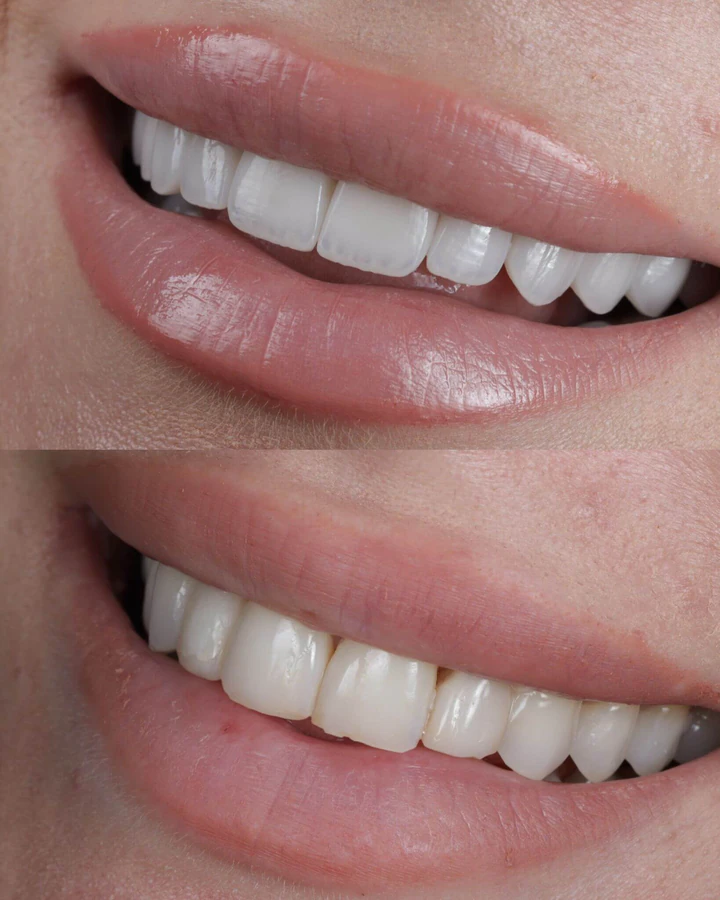 Caz Before & After realizat de Dr. Yazan Aq.