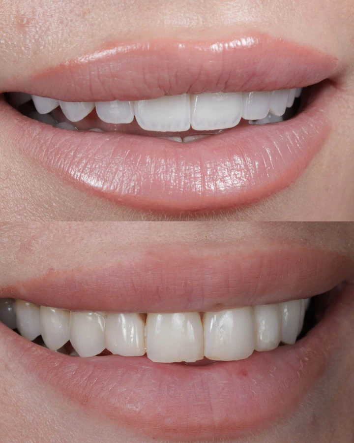 Caz Before & After realizat de Dr. Yazan Aq.