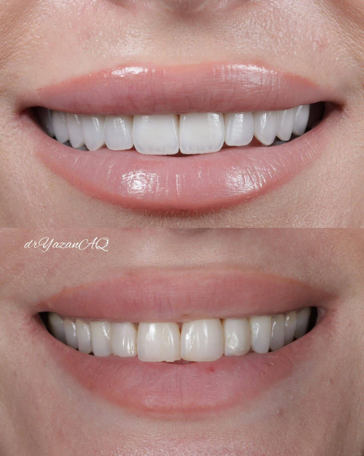 Caz Before & After realizat de Dr. Yazan Aq.