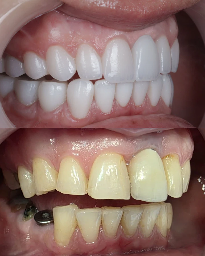 Caz Before & After realizat de Dr. Yazan Aq.