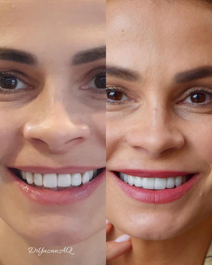 Caz Before & After realizat de Dr. Yazan Aq.