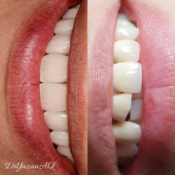 Caz Before & After realizat de Dr. Yazan Aq.