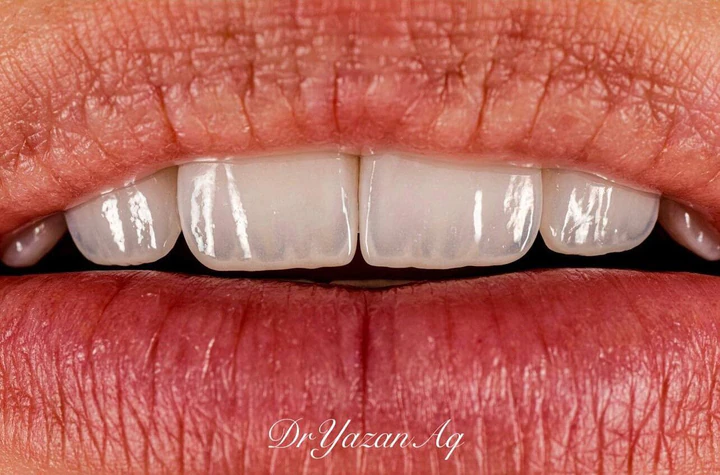 Caz Before & After realizat de Dr. Yazan Aq.