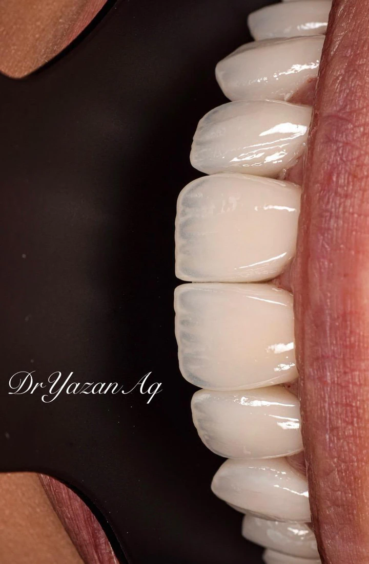 Caz Before & After realizat de Dr. Yazan Aq.