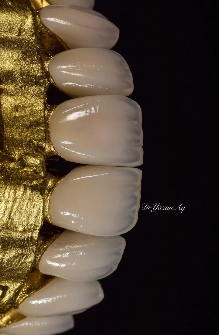 Caz Before & After realizat de Dr. Yazan Aq.