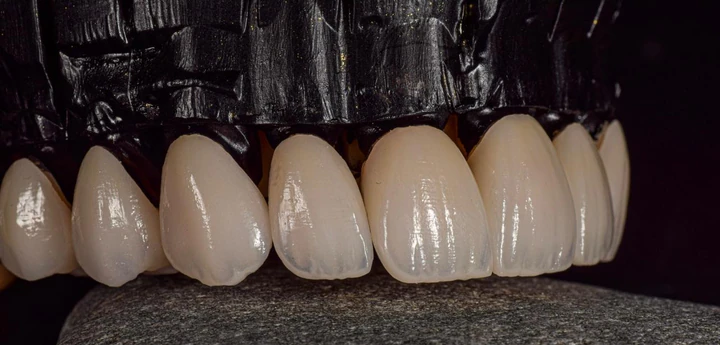 Caz Before & After realizat de Dr. Yazan Aq.