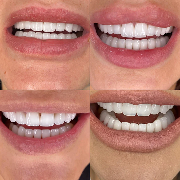 Caz Before & After realizat de Dr. Yazan Aq.