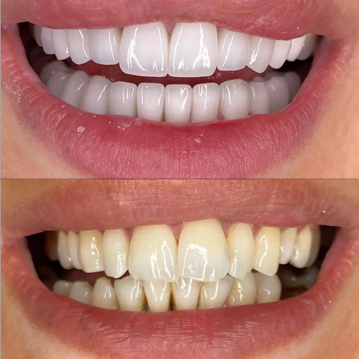 Caz Before & After realizat de Dr. Yazan Aq.