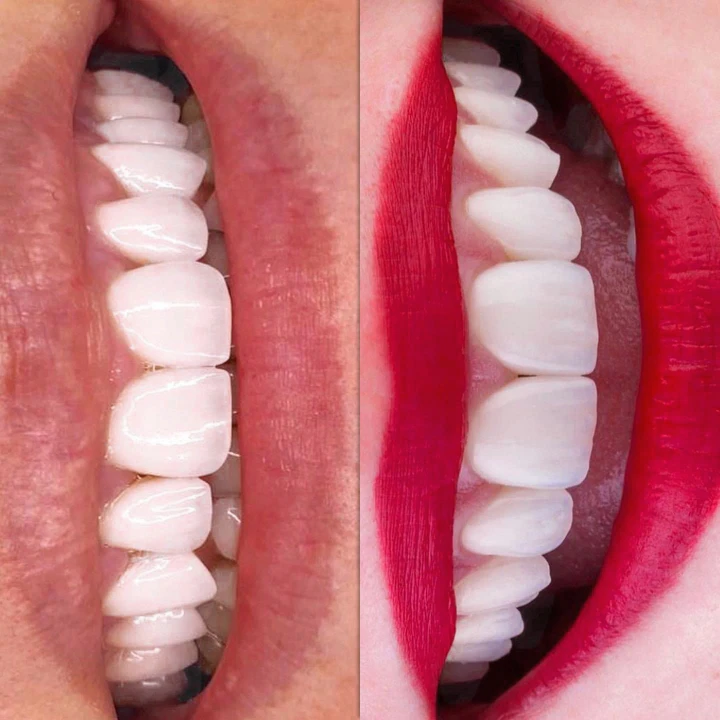Caz Before & After realizat de Dr. Yazan Aq.