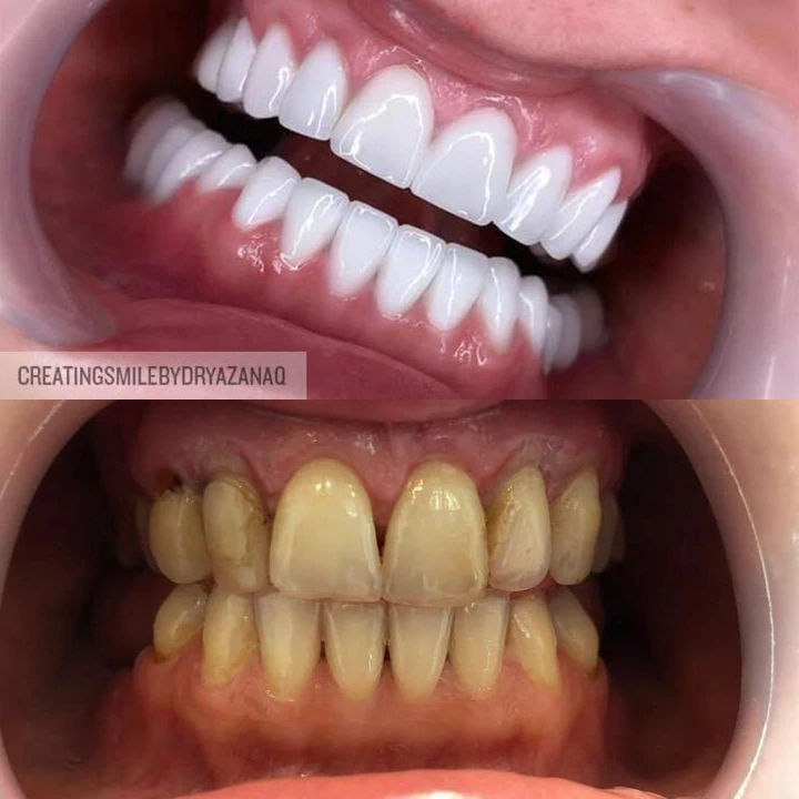 Caz Before & After realizat de Dr. Yazan Aq.