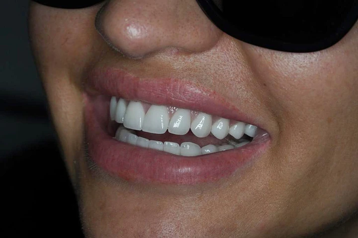 Caz Before & After realizat de Dr. Yazan Aq.