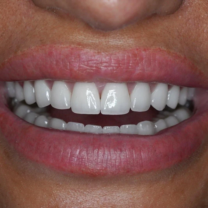Caz Before & After realizat de Dr. Yazan Aq.