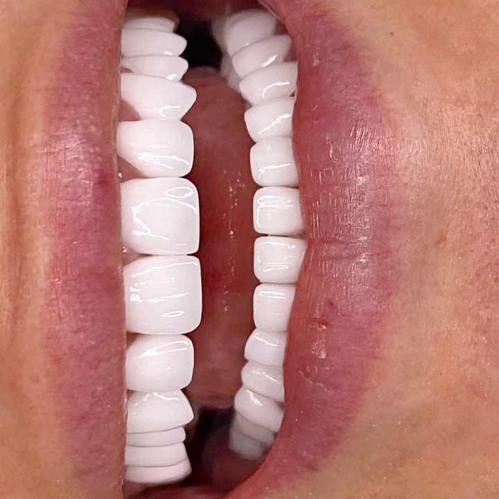 Caz Before & After realizat de Dr. Yazan Aq.