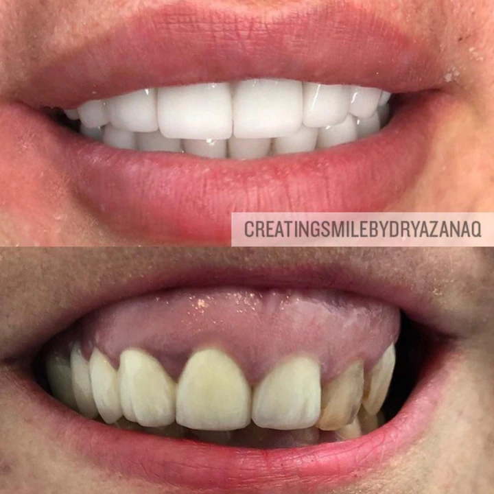 Caz Before & After realizat de Dr. Yazan Aq.