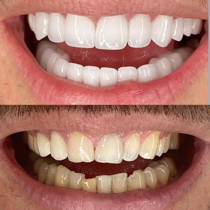 Caz Before & After realizat de Dr. Yazan Aq.