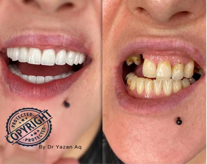 Caz Before & After realizat de Dr. Yazan Aq.