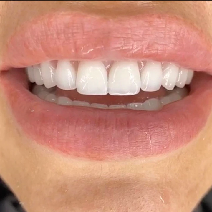 Caz Before & After realizat de Dr. Yazan Aq.