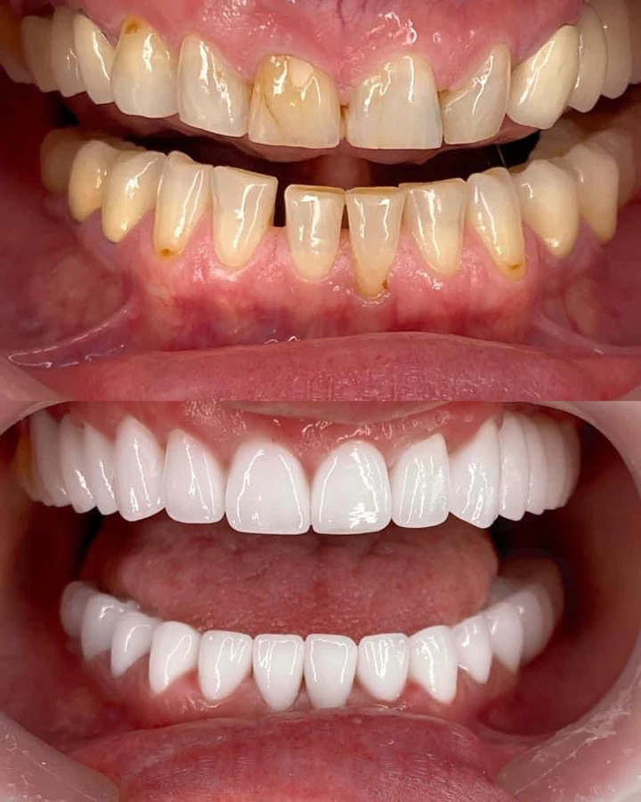 Caz Before & After realizat de Dr. Yazan Aq.