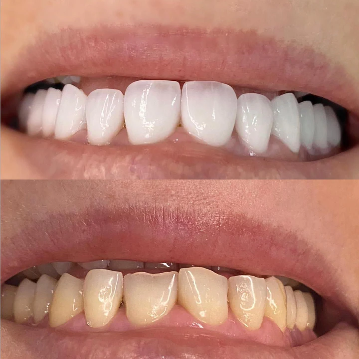 Caz Before & After realizat de Dr. Yazan Aq.