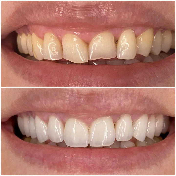 Caz Before & After realizat de Dr. Yazan Aq.