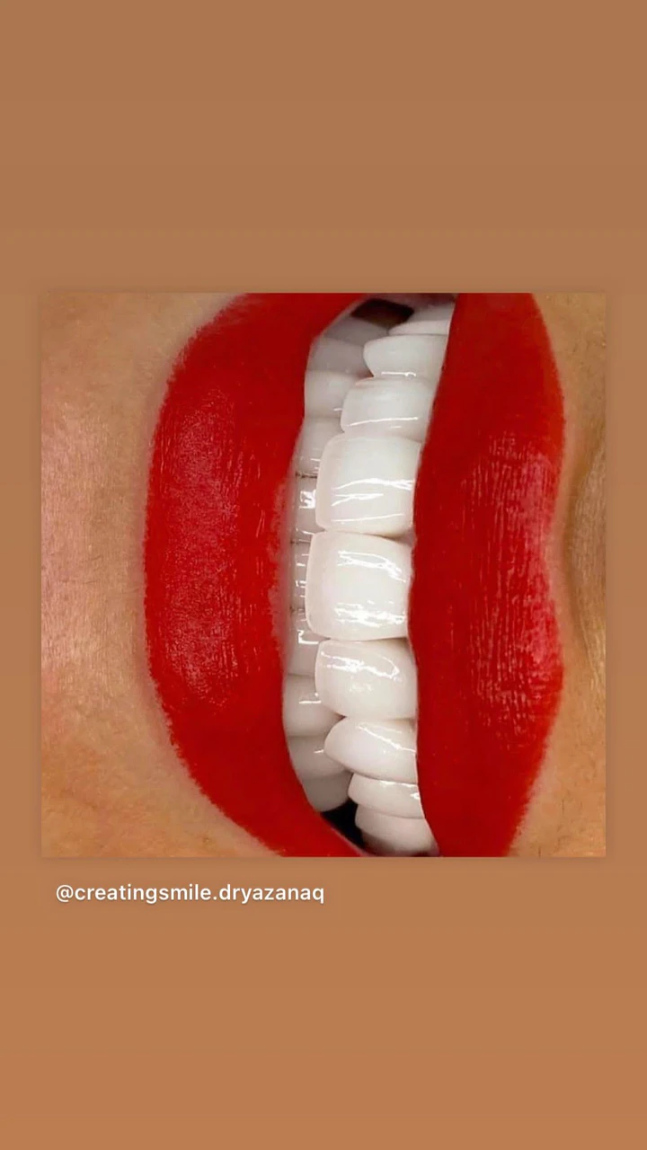 Caz Before & After realizat de Dr. Yazan Aq.