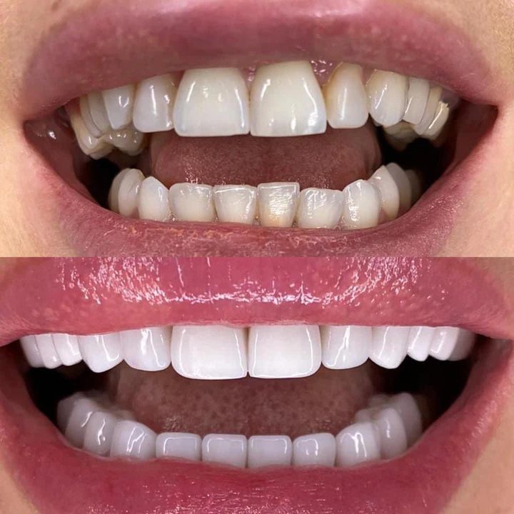 Caz Before & After realizat de Dr. Yazan Aq.
