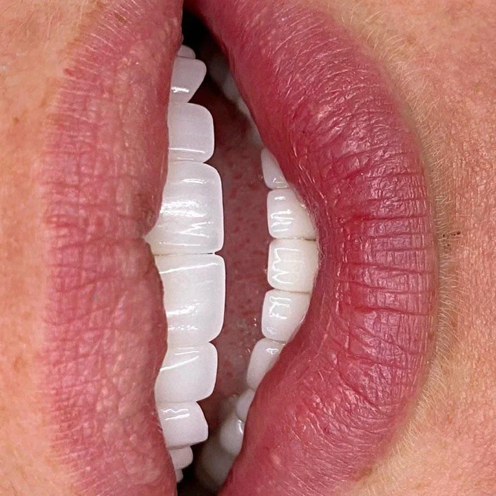 Caz Before & After realizat de Dr. Yazan Aq.