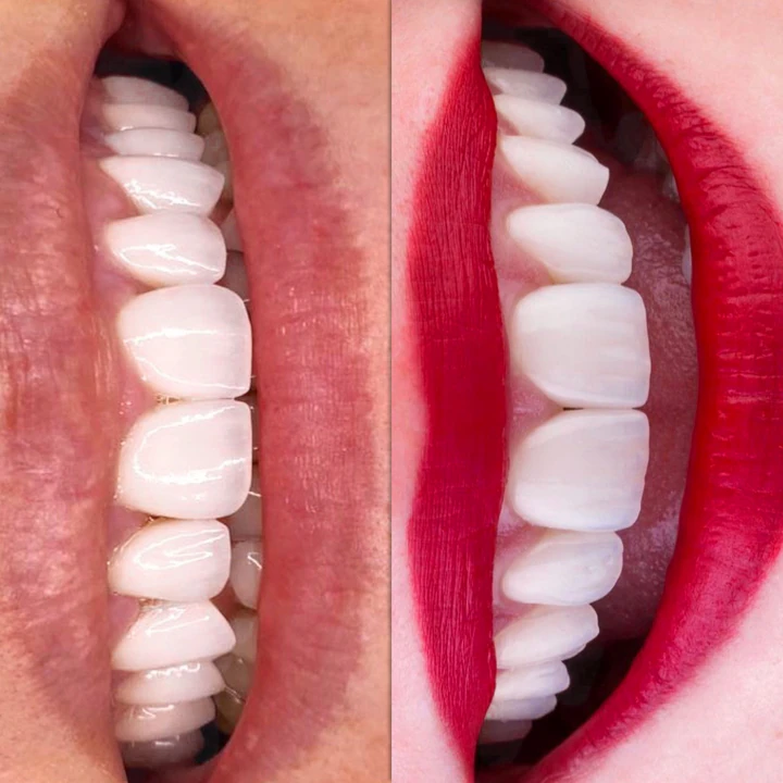 Caz Before & After realizat de Dr. Yazan Aq.