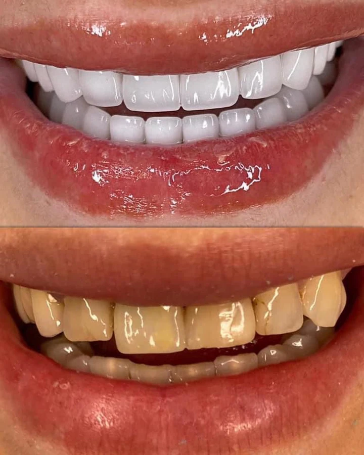 Caz Before & After realizat de Dr. Yazan Aq.