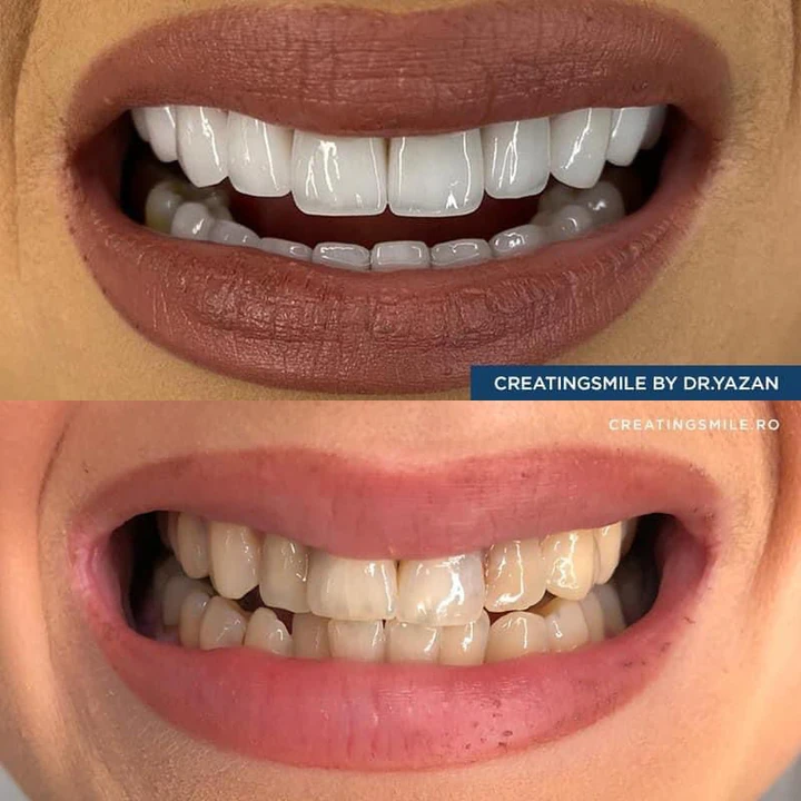 Caz Before & After realizat de Dr. Yazan Aq.