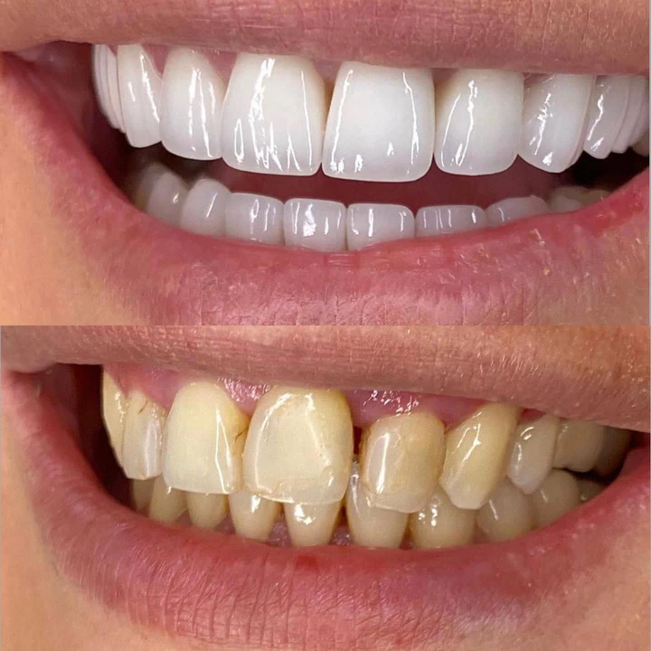 Caz Before & After realizat de Dr. Yazan Aq.
