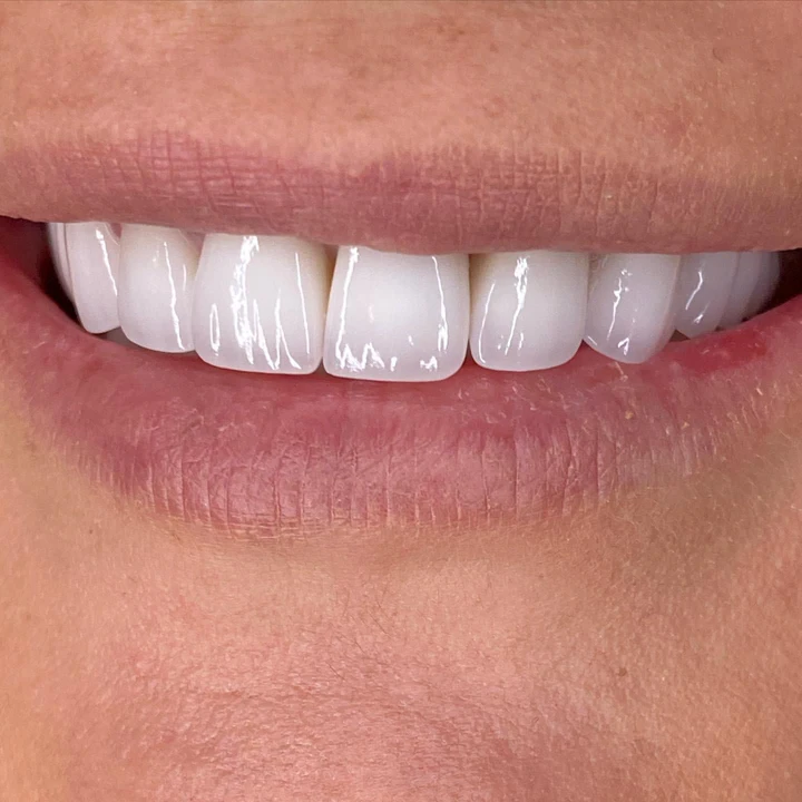 Caz Before & After realizat de Dr. Yazan Aq.
