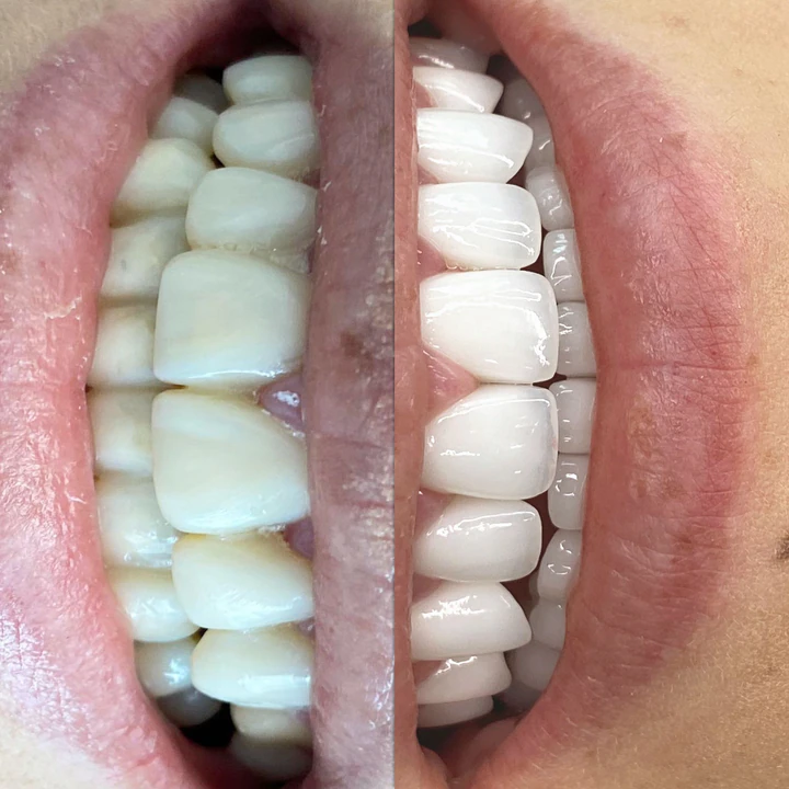Caz Before & After realizat de Dr. Yazan Aq.