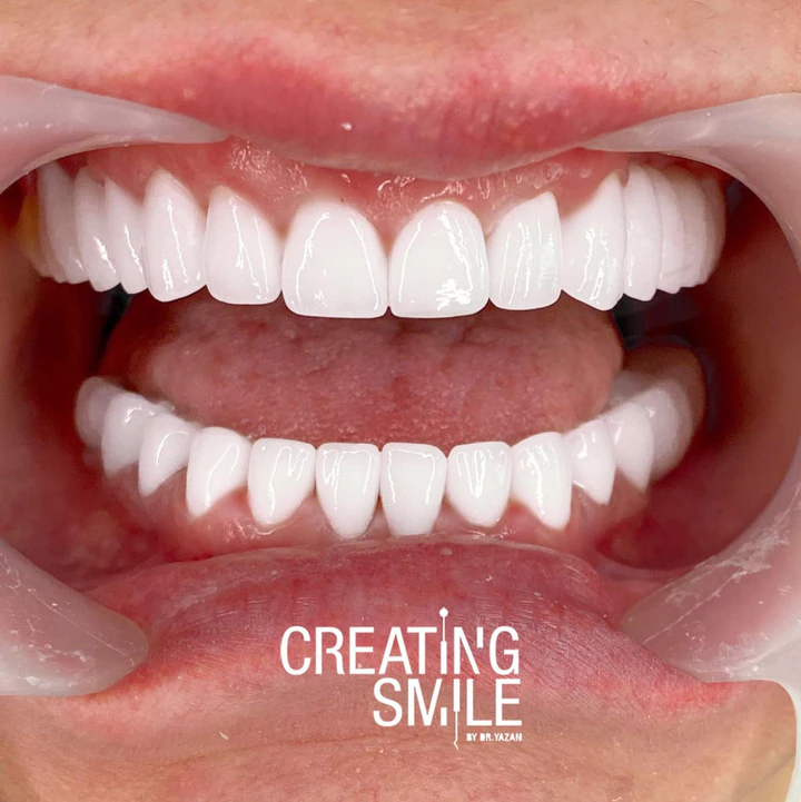Caz Before & After realizat de Dr. Yazan Aq.