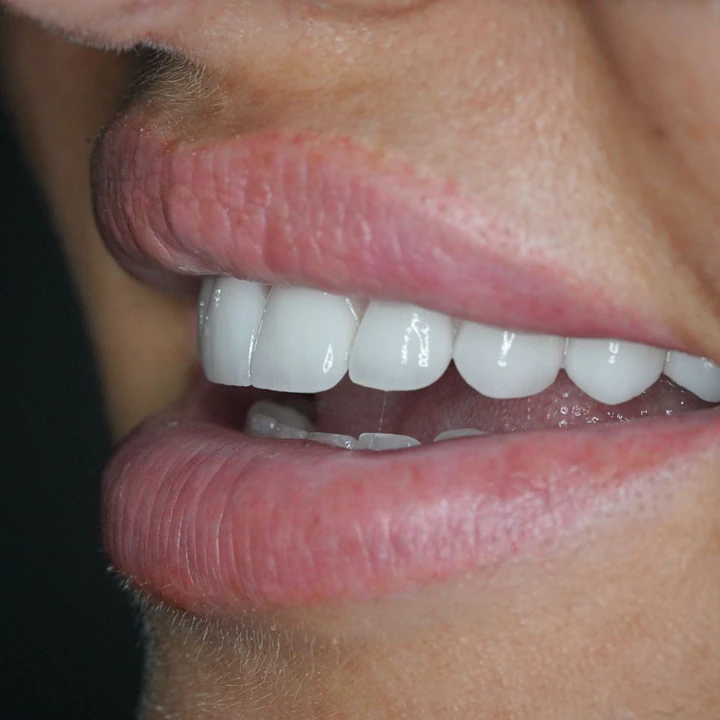 Caz Before & After realizat de Dr. Yazan Aq.