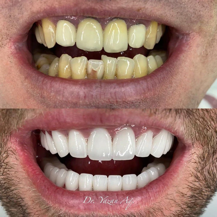 Caz Before & After realizat de Dr. Yazan Aq.