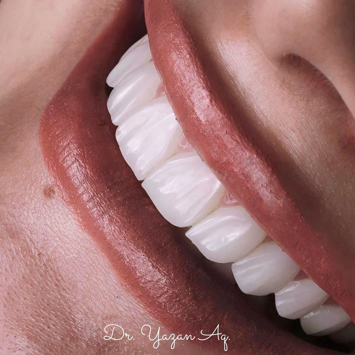 Caz Before & After realizat de Dr. Yazan Aq.