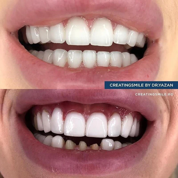 Caz Before & After realizat de Dr. Yazan Aq.