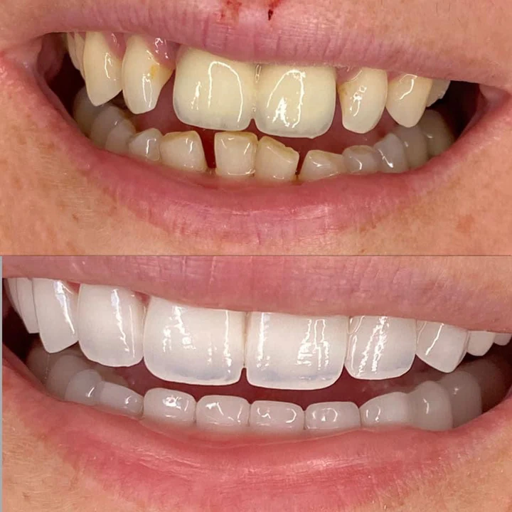 Caz Before & After realizat de Dr. Yazan Aq.