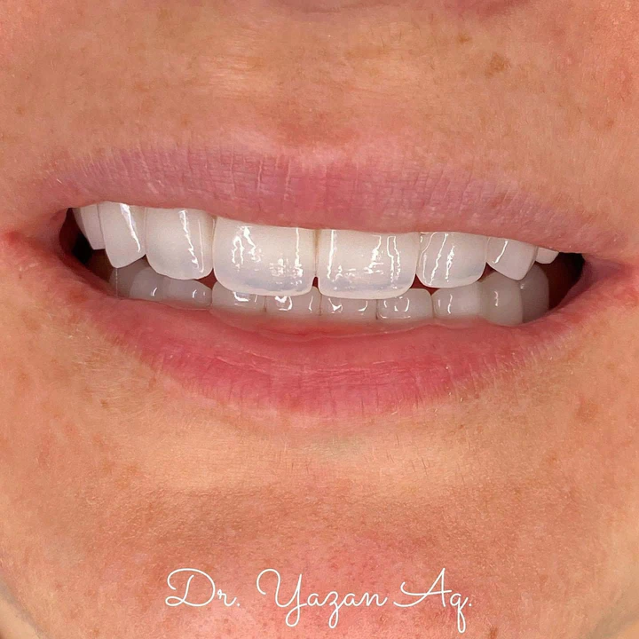 Caz Before & After realizat de Dr. Yazan Aq.